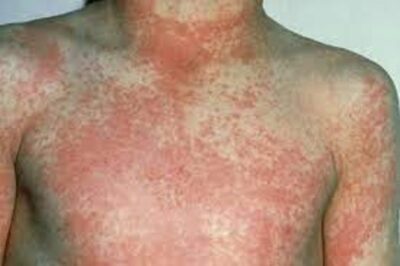 Chest Rash 400x266 1